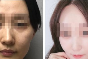 浙江省人民医院整形外科孙燚整形价格表附热玛吉案例展示