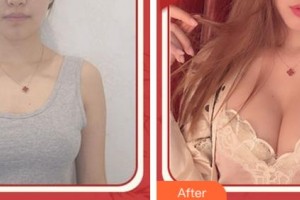 杭州华山连天美医疗美容整形医院李超整形价格表附自体脂肪隆胸案例展示