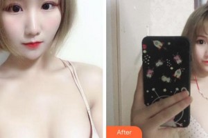 杭州时光医疗美容医院吕敏整形价格表附自体脂肪隆胸案例展示