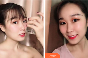 广州爱康健口腔门诊部冯晓瑛整形价格表附牙齿隐形矫正案例展示