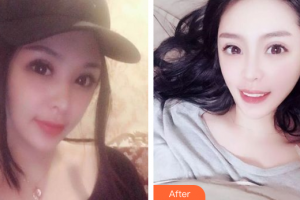 广州梅里奥口腔门诊部王鸿烈整形价格表附牙齿隐形矫正案例展示