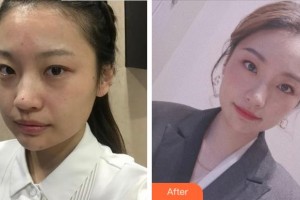 杭州艺星医疗美容医院柏亚萍整形价格表附激光祛斑案例展示