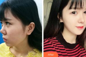 杭州星颜医疗美容诊所高寿松整形价格表附鼻部综合案例展示