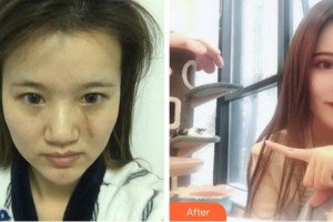杭州时光医疗美容医院肖睿整形价格表附手术祛疤案例展示
