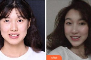 杭州美奥口腔门诊部黄肖整形价格表附牙齿隐形矫正案例展示