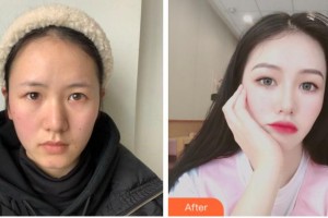 杭州富阳柏氏眼科医院诸力伟整形价格表附眼部综合案例展示