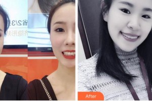 杭州牙科医院林亨哲整形价格表附牙齿隐形矫正案例展示