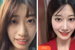 杭州协友口腔门诊部钱小丽整形价格表附牙齿陶瓷矫正案例展示