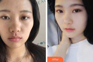 杭州婵之媛医疗美容诊所崔在爀整形价格表附热玛吉案例展示