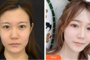 杭州婵之媛医疗美容诊所孙华昌整形价格表附热玛吉案例展示