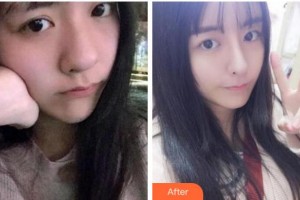 杭州依萱绮医疗美容诊所周琦整形价格表附热玛吉案例展示