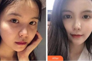 杭州依萱绮医疗美容诊所李营整形价格表附热玛吉案例展示