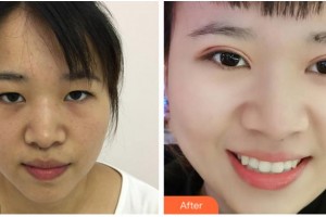 杭州华厦眼科医院陈偕穗整形价格表附定点双眼皮案例展示