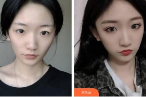 杭州华厦眼科医院李夏珍整形价格表附切开双眼皮案例展示