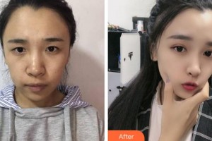 杭州华厦眼科医院张宏亮整形价格表附眼部综合案例展示