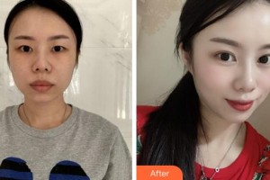 杭州华厦眼科医院杨新整形价格表附眼部综合案例展示