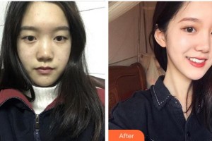 杭州华厦眼科医院陈彬彬整形价格表附眼部综合案例展示