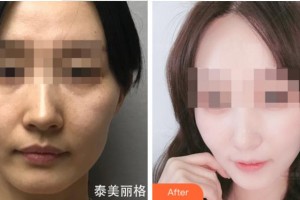 杭州睿妍医疗美容诊所司婷婷整形价格表附热玛吉案例展示