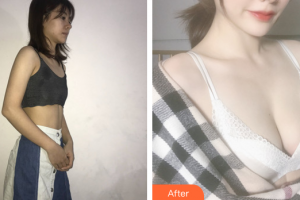 惠州元辰医疗美容门诊部袁新平整形价格表附假体隆胸案例展示