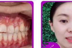 杭州良渚口腔门诊部方豪整形价格表附牙齿隐形矫正案例展示