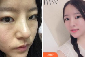 杭州港丽医疗美容诊所刘庭华整形价格表附切开双眼皮案例展示