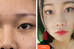 宁波典范医疗美容门诊部徐斌整形价格表附切开双眼皮案例展示
