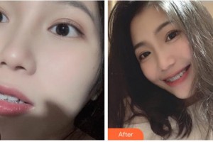温州华君美口腔门诊部王光耀整形价格表附自锁托槽矫正案例展示