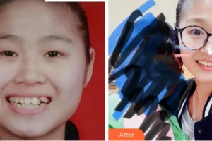 温州蓝芽口腔门诊部赵微整形价格表附金属托槽矫正案例展示
