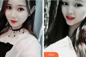 温州蓝芽口腔门诊部杨新新整形价格表附牙齿隐形矫正案例展示
