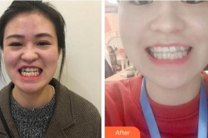 温州牙博士口腔门诊部魏谋达整形价格表附牙齿隐形矫正案例展示