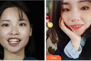 温州牙博士口腔门诊部吕昊昕整形价格表附金属托槽矫正案例展示