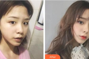 嘉兴华山医疗美容医院伞光整形价格表附切开双眼皮案例展示