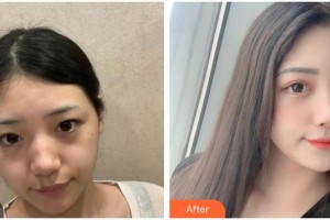 嘉兴华山医疗美容医院谢惠芬整形价格表附激光祛斑案例展示