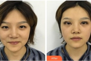 嘉兴华山医疗美容医院冉晓娟整形价格表附开内眼角案例展示