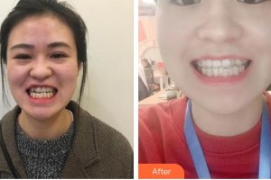 嘉兴市曙光中西医结合医院整形美容科赵云整形价格表附牙齿隐形矫正案例展示
