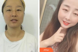 嘉兴华山医疗美容医院郭豪整形价格表附白瓷娃娃案例展示