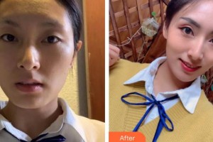 嘉兴禾美医疗美容医院柳军整形价格表附埋线提升案例展示