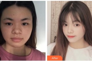 嘉兴禾美医疗美容医院梁海元整形价格表附埋线提升案例展示
