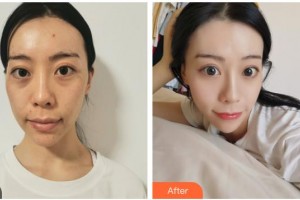 嘉兴禾美医疗美容医院赵学燕整形价格表附埋线提升案例展示