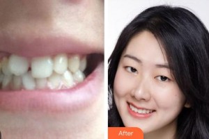 嘉兴禾美医疗美容医院李俊峰整形价格表附牙齿陶瓷矫正案例展示