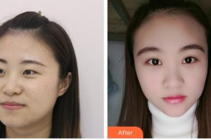 嘉兴爱尔眼科医院张文凤整形价格表附眼部综合案例展示