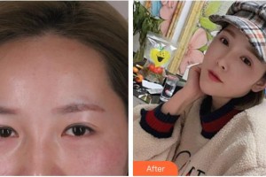 嘉兴爱尔眼科医院李文生整形价格表附眼部综合案例展示