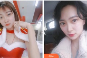 嘉兴爱尔眼科医院赵春会整形价格表附切开双眼皮案例展示