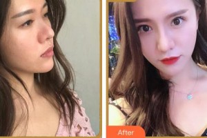 湖州长兴爱尔眼科医院陈培正整形价格表附眼部综合案例展示