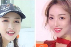 绍兴博雅口腔医院黄海波整形价格表附隐形托槽矫正案例展示