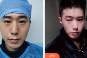 绍兴袍江医院眼科李厚硕整形价格表附眼部综合案例展示