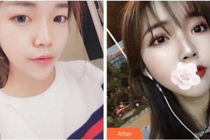 绍兴袍江医院眼科屠清安整形价格表附切开双眼皮案例展示