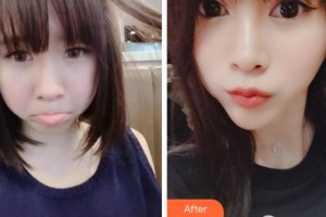 绍兴袍江医院眼科王湘娟整形价格表附眼部综合案例展示