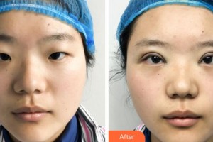 绍兴袍江医院眼科李田整形价格表附眼部综合案例展示