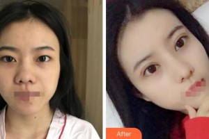 绍兴市柯桥区中医医院眼科李伟整形价格表附切开双眼皮案例展示